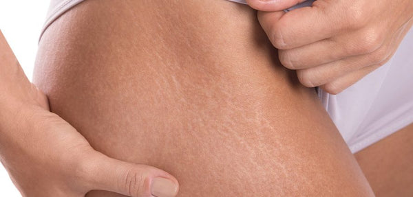 Nanocolor Infusion for Stretch Marks FAQs