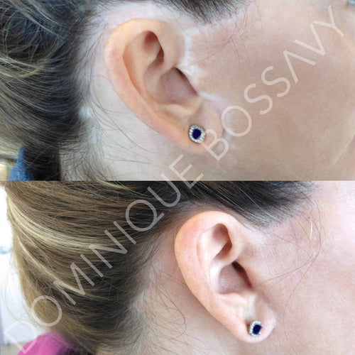 Facelift Scar