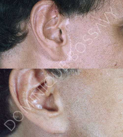 Facelift Scar