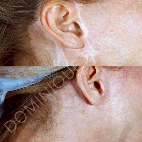 Facelift Scar