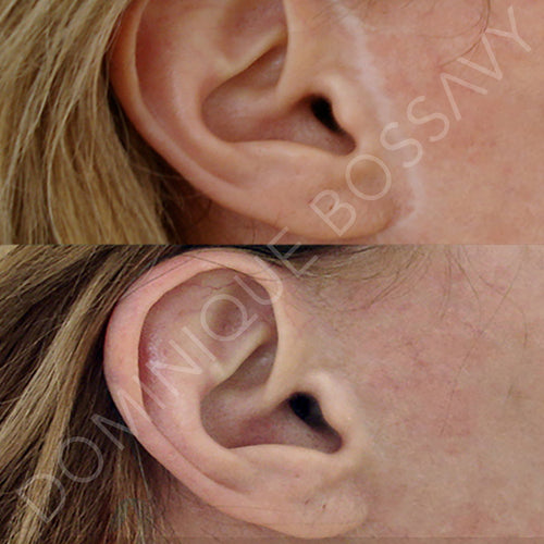 Facelift Scar