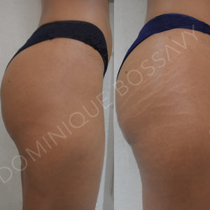 Stretchmarks