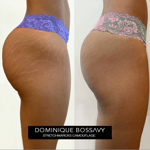 Stretchmarks