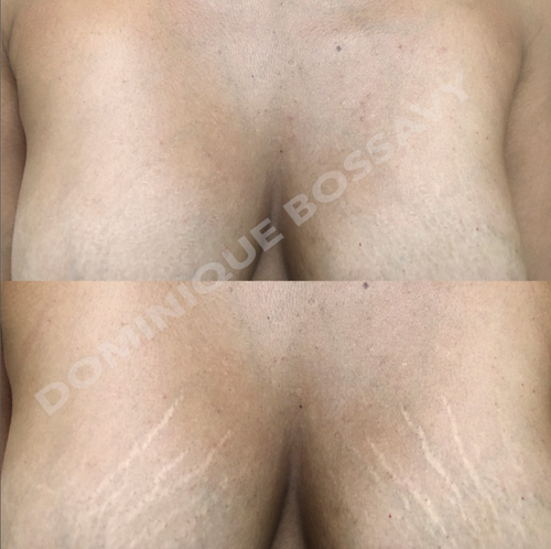 STRETCHMARKS